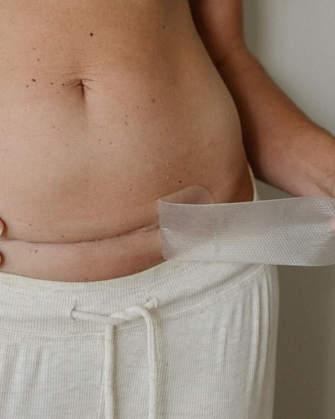 C-Section Recovery: What Nobody Tells You